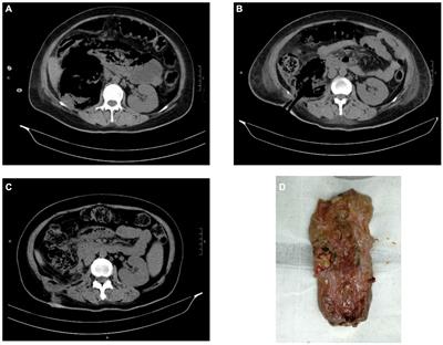 Report on the diagnosis and treatment of 3 cases of emphysematous pyelonephritis with two different outcomes